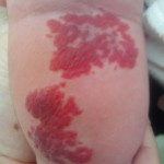赤ちゃんの苺状血管腫ってどんなの？写真画像はコチラ！